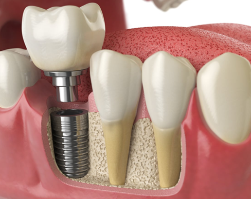 Dental Implants