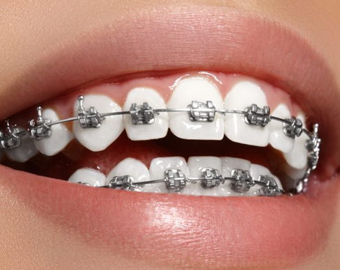 Orthodontic Treatment