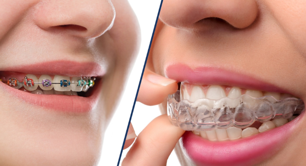 Orthodontic treatment (Braces/Aligners)