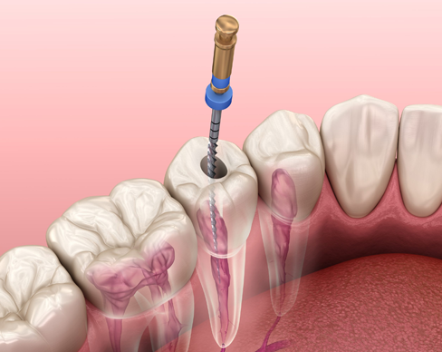 Root Canal Treatment
