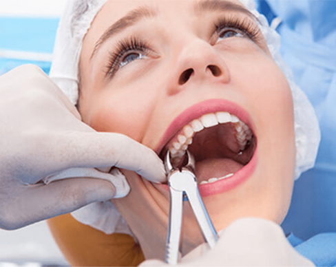 Tooth Extraction